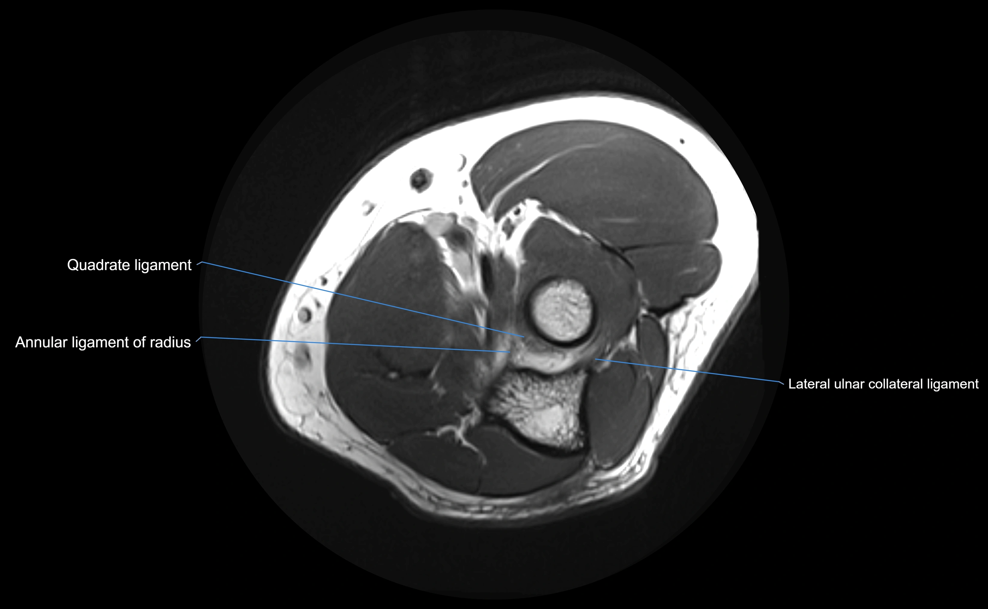 MRI elbow ligaments axial cross sectional anatomy 3T  radiology  image-img-00001-00020.webp